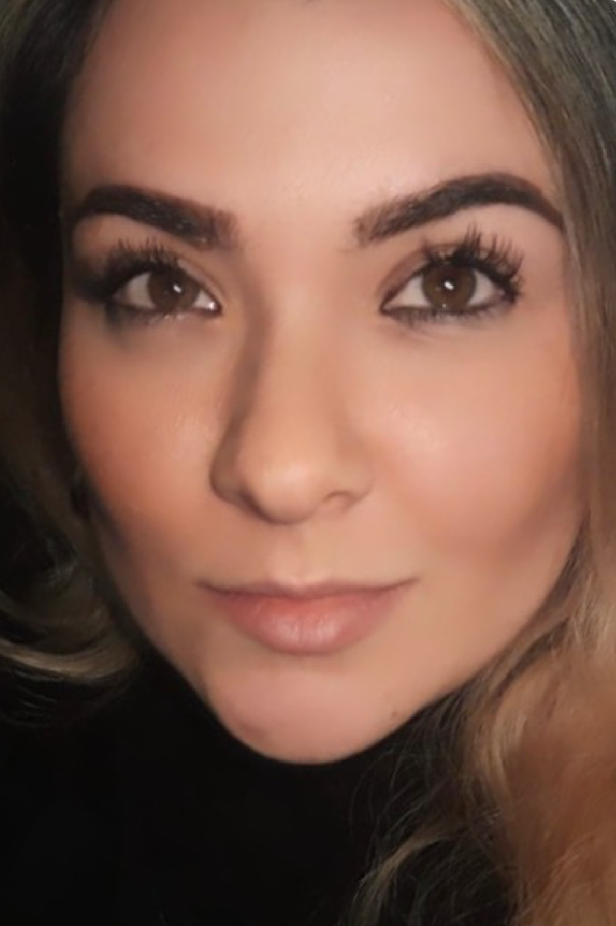 Después Bichectomía