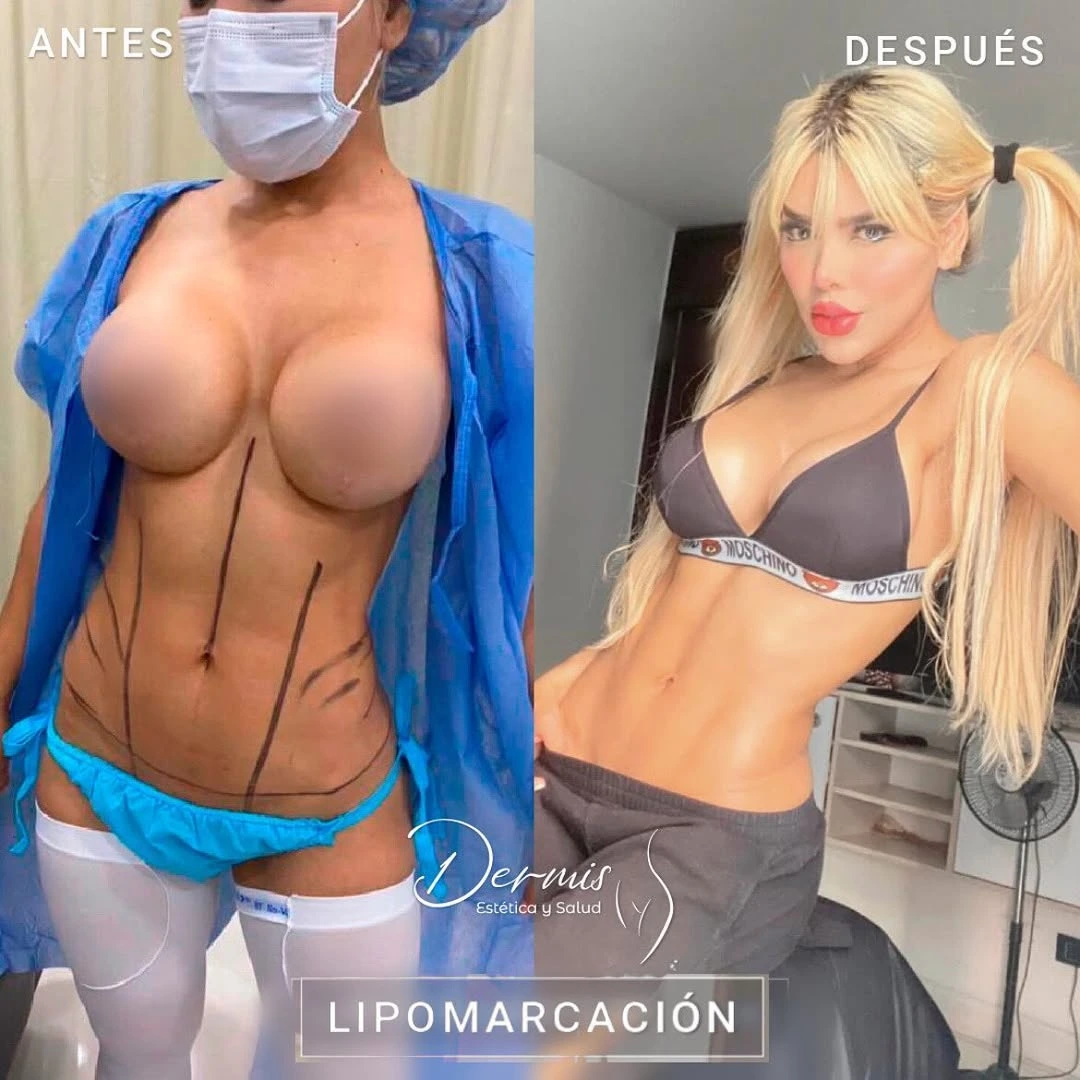 Antes / Después